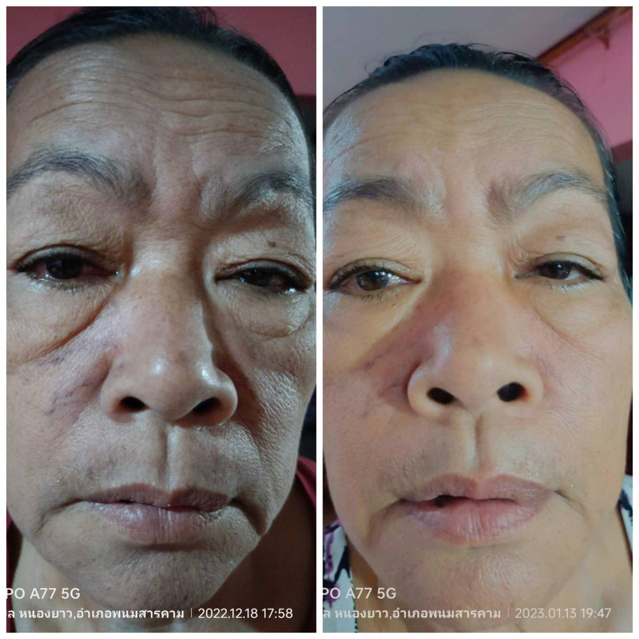 ลดฝ้า สิวอักเสบ รอยดำแดง เห็นการเปลี่ยนแปลงตั้งแต่7วันแรกที่ใช้